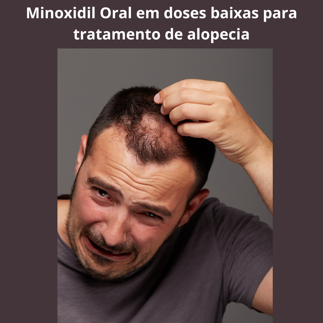 Minoxidil Oral em baixas doses para tratamento de alopecia